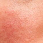 Rosacea